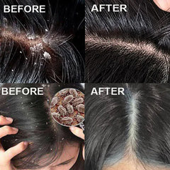 Fast Anti Dandruff Hair Oil Control Relieve Itching Treatment Repair Scalp Cleaning Exfoliating Products Antipruritic Hair Care