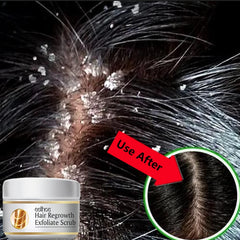 Fast Anti Dandruff Hair Oil Control Relieve Itching Treatment Repair Scalp Cleaning Exfoliating Products Antipruritic Hair Care